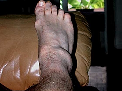 I think I sprained my ankle...Opinions???-ankle-ii.jpg