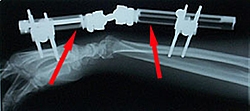 It's official--E Dock, THE place to be!!-wrist_external_fixator_xray_lateral-1-large-.jpg