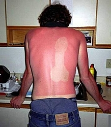 The B.S. Thread-sunburn.jpg